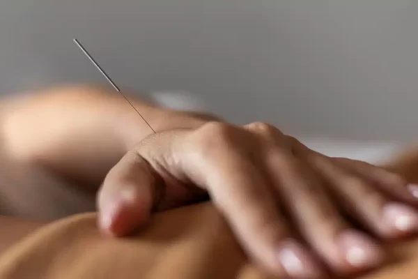 Cómo-es-el-tratamiento-con-acupuntura