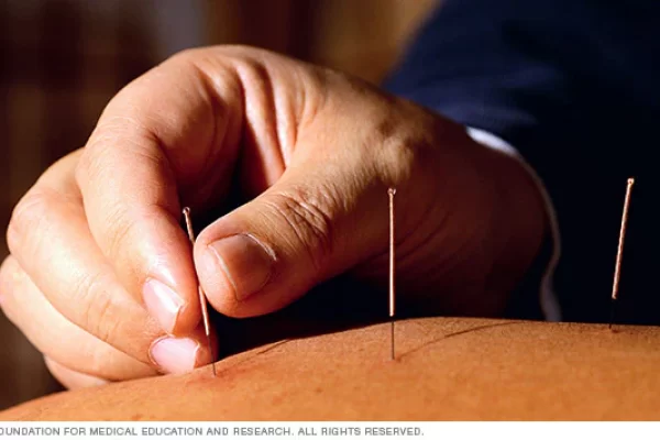 complementary-medicine-acupuncture-8col